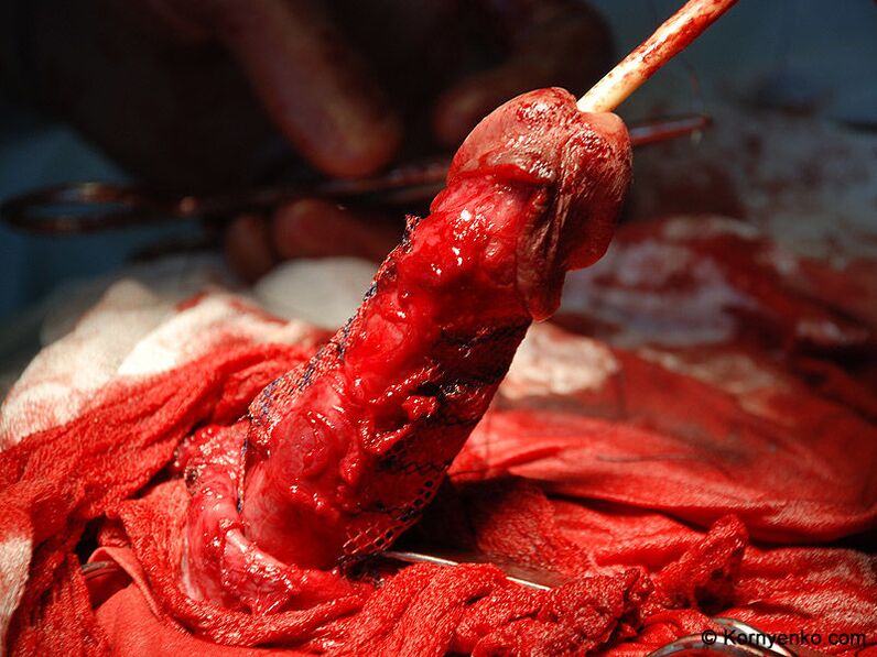 instalimi i një matrice kolagjeni për zgjerimin e penisit