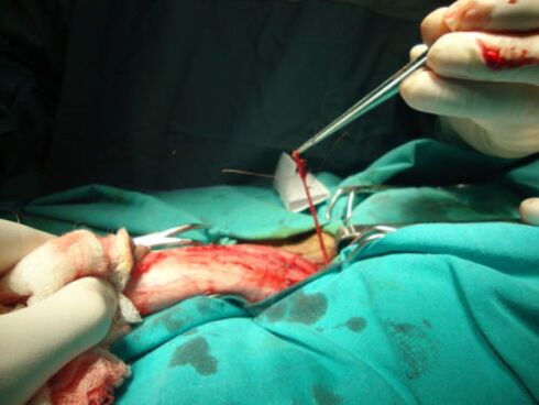 kirurgji për zgjerimin e penisit