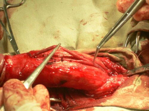 kryerja e operacionit për zgjerimin e penisit